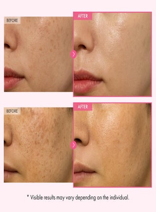 before and after glutathione cream Skin Lightening Cream, Packaging size: 50 gm at  999/pack in Dehradun Before and After Results 