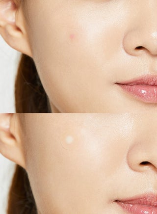 Acne Pimple Master Patch 24 Patches 24 Patches - view 4