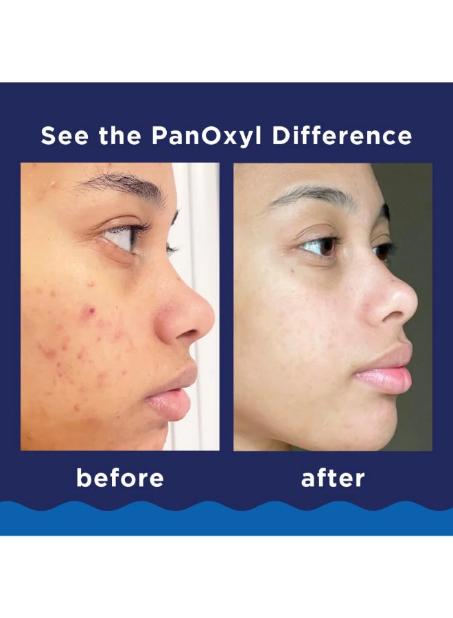PanOxyl - Pack Of 2 Acne Foaming Wash 156grams - Image 1