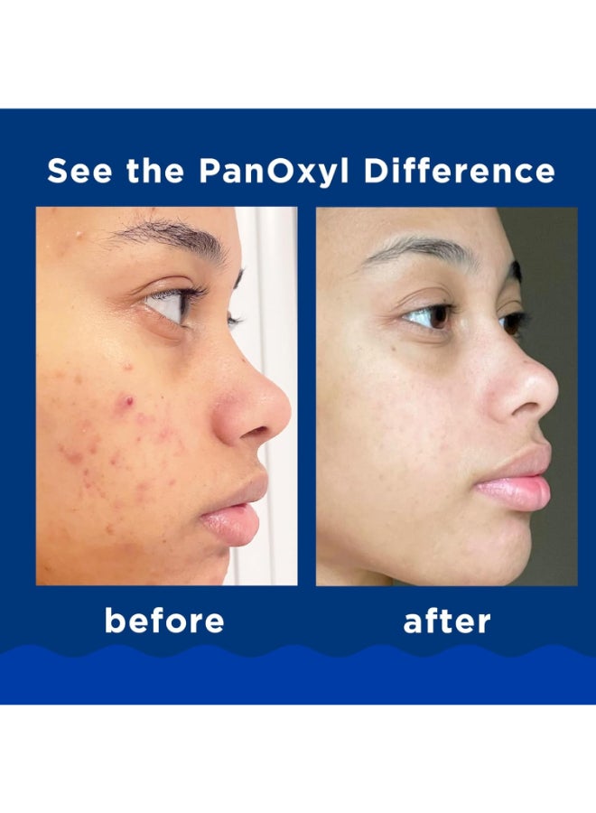 PanOxyl - Pack Of 2 Acne Foaming Wash 156grams - Image 1