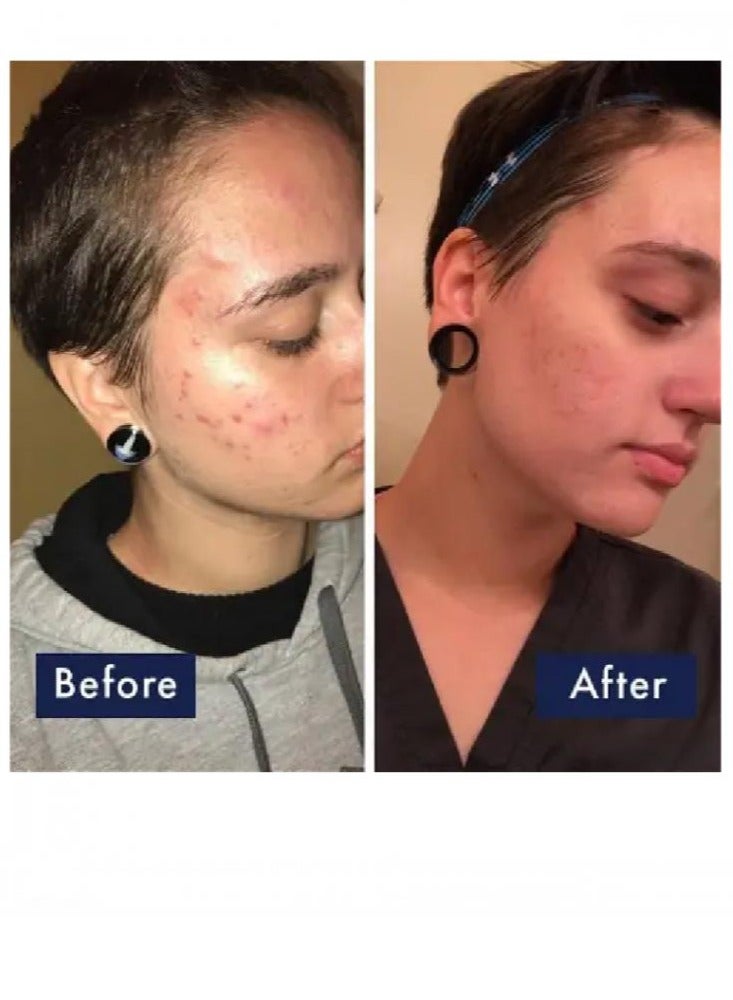 PanOxyl - Benzoyl Peroxide 4% Acne Foaming Wash White Panoxyl 170grams - Image 1