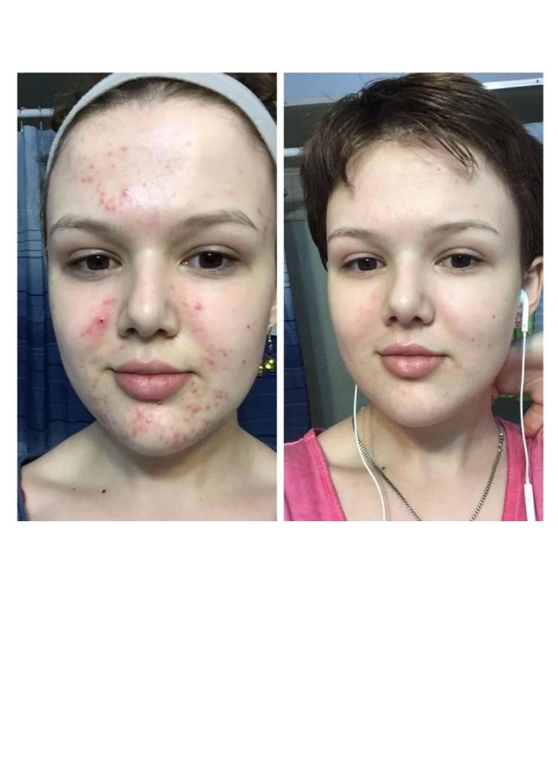 PanOxyl - Benzoyl Peroxide 4% Acne Foaming Wash White Panoxyl 170grams - Image 1