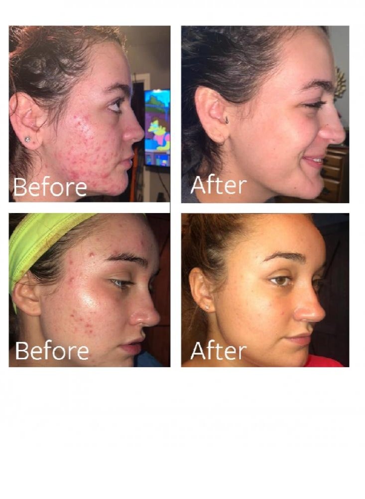 PanOxyl - Benzoyl Peroxide 4% Acne Foaming Wash White Panoxyl 170grams - Image 1