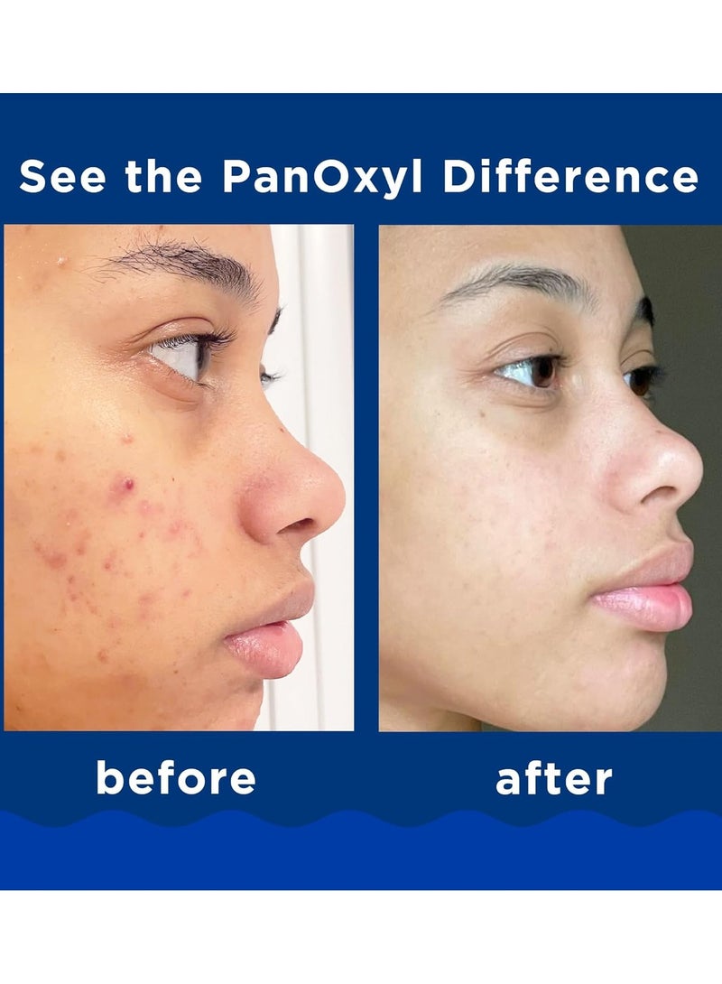 PanOxyl - Acne Foaming Wash Benzoyl Peroxide 10% Maximum Strength 156 gramsgrams - Image 1