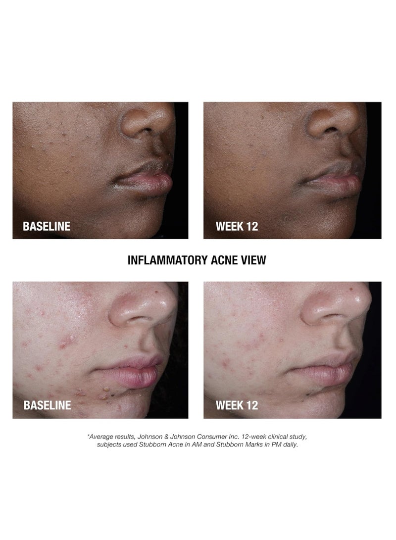 Neutrogena Neutrogena Stubborn Acne AM Face Treatment with 2.5% Micronized Benzoyl Peroxide Acne Medication, Oil-Free Daily Facial Treatment Reduces Size & Redness of Breakouts, Paraben-Free, 2.0 oz 2.0 ozounce - Image 3