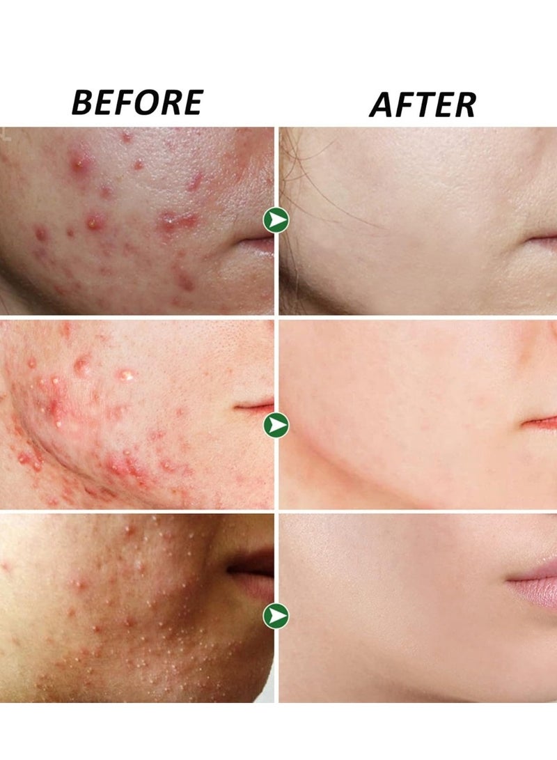 YOUBUY Anti Acne Remove Acne and Treats Blackheads Gel for Night Use Remove Acne Pimple and Treats Blackhead with Salicylic Acid Oil Control Shrink Pores Redness Relief Skin Lightening Scar Fade Cream Acne Remover Cream 20g - Image 3