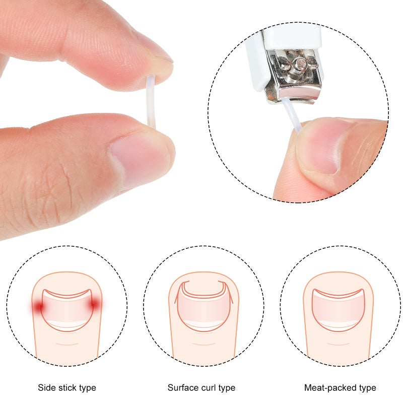 Maitys 60 Pieces Ingrown Toenail Corrector Strips Ingrown Toe Nail Correction Brace Correction Clip Toe Nail Straightening Recover Patch Curved Toenail Corrector for Women Men Foot Care, 2 Styles - Image 4