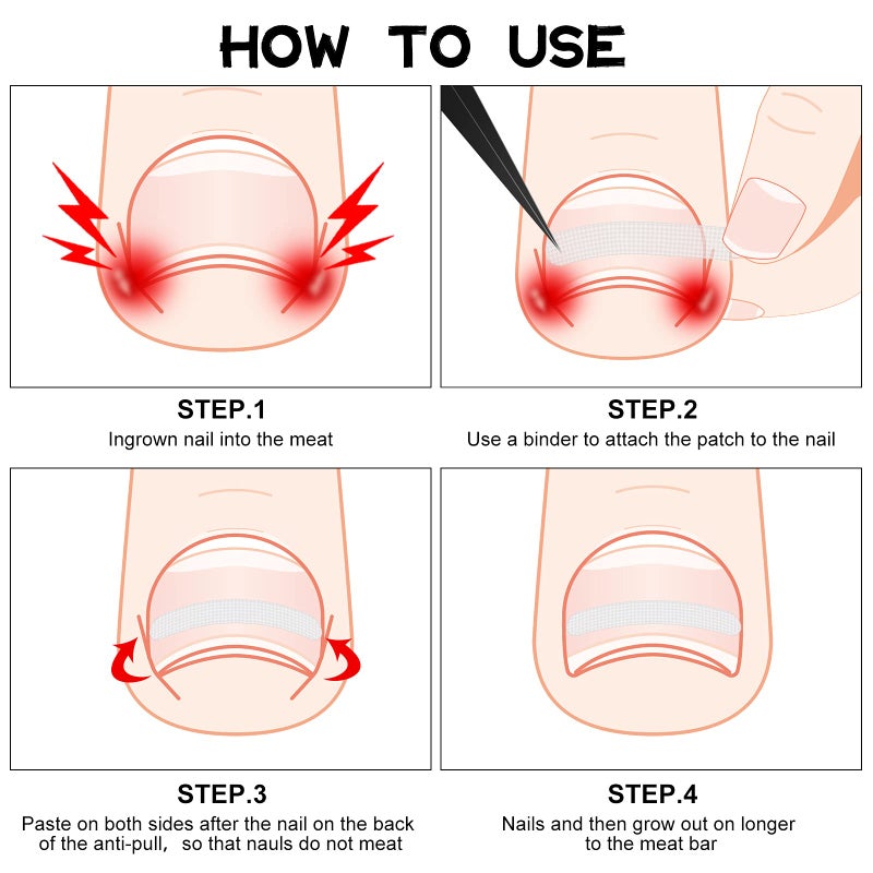 Maitys 60 Pieces Ingrown Toenail Corrector Strips Ingrown Toe Nail Correction Brace Correction Clip Toe Nail Straightening Recover Patch Curved Toenail Corrector for Women Men Foot Care, 2 Styles - Image 5