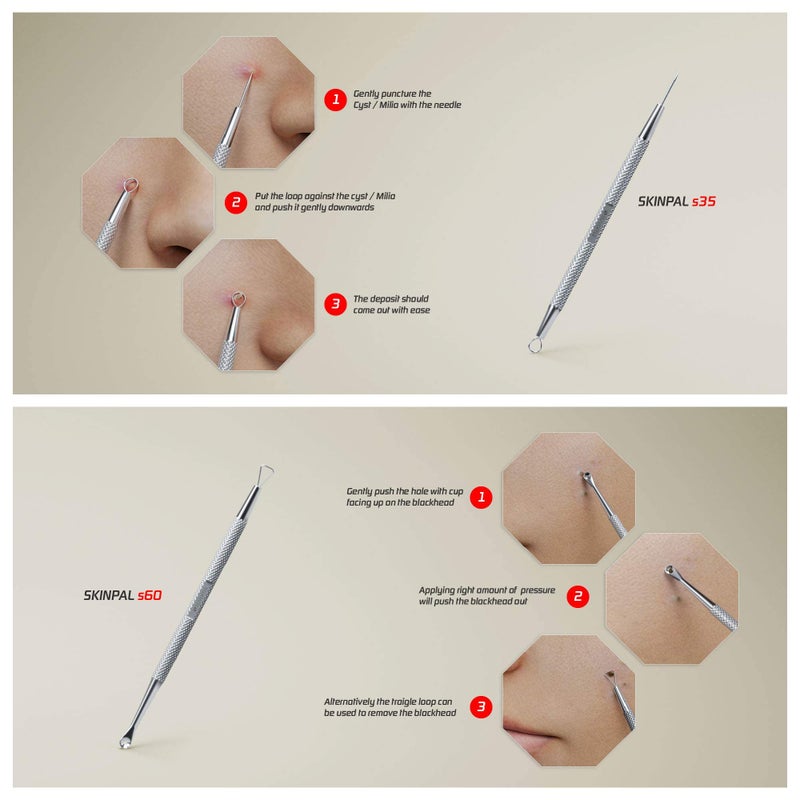 Suvorna Pimple Popper Tool Kit | Milia Remover | Lancets for Facial Extraction | White head Extractor Tool for Face | Comedone Extractor | Blackhead Remover tool | Acne Needle Tool & Cyst Removal Tool - Image 2