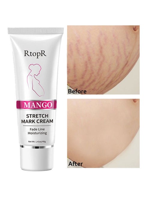 Mango Stretch Mark Cream for Fade Line Moisturizing, Contains Mango Essence, Can Promote Cell Regeneration, Repair Necrotic Cells and Enhance Skin Elasticity, Designed for Mother's Stretch Marks