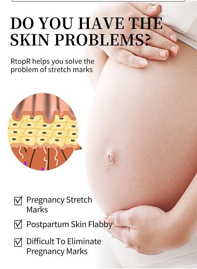 Mango Stretch Mark Cream for Fade Line Moisturizing, Contains Mango Essence, Can Promote Cell Regeneration, Repair Necrotic Cells and Enhance Skin Elasticity, Designed for Mother's Stretch Marks