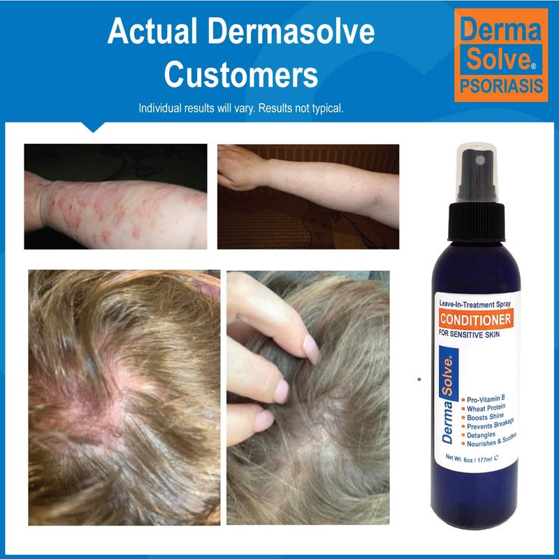 Dermasolve Psoriasis Leave-In-Treatment and Styling Spray Conditioner for Seborrheic Dermatitis, Sensitive Skin, Detangle, De-Flake, Soothing Anti Dandruff, Dry Scalp Repair for Damaged Hair - Image 5