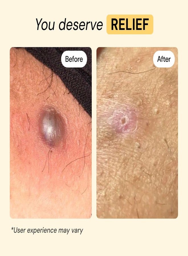 MyMagicHealer Universal Flare Care – Solution for Everyday Skin Flare-Ups | Drawing Salve for Boils & Cysts, Hidradenitis Suppurativa, Folliculitis | Irritated Skin and Chafing Relief 4 oz - Image 3