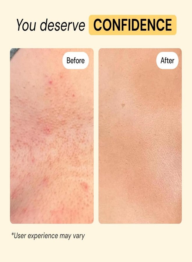 MyMagicHealer Universal Flare Care – Solution for Everyday Skin Flare-Ups | Drawing Salve for Boils & Cysts, Hidradenitis Suppurativa, Folliculitis | Irritated Skin and Chafing Relief 4 oz - Image 5