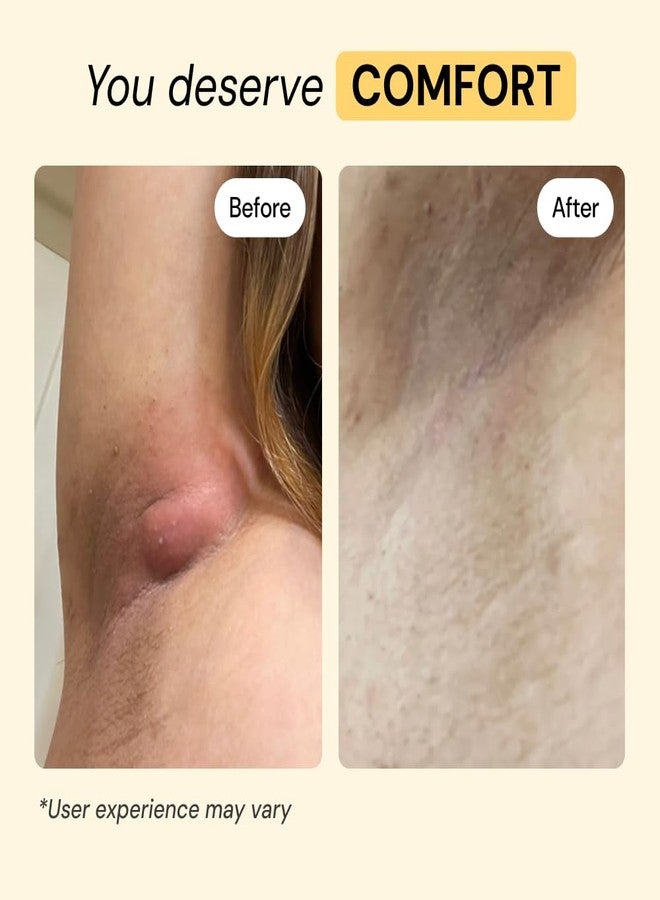MyMagicHealer Universal Flare Care – Solution for Everyday Skin Flare-Ups | Drawing Salve for Boils & Cysts, Hidradenitis Suppurativa, Folliculitis | Irritated Skin and Chafing Relief 4 oz - Image 4