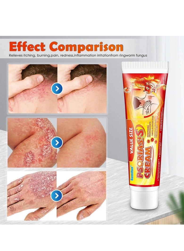 Sumifun كريم الصدفية، كريم سعفة الجلد، كريمات الصدفية العشبية الصينية الطبيعية، تعمل بشكل فعال على قمع الصدفية والحكة الجلدية من خلال - Image 2