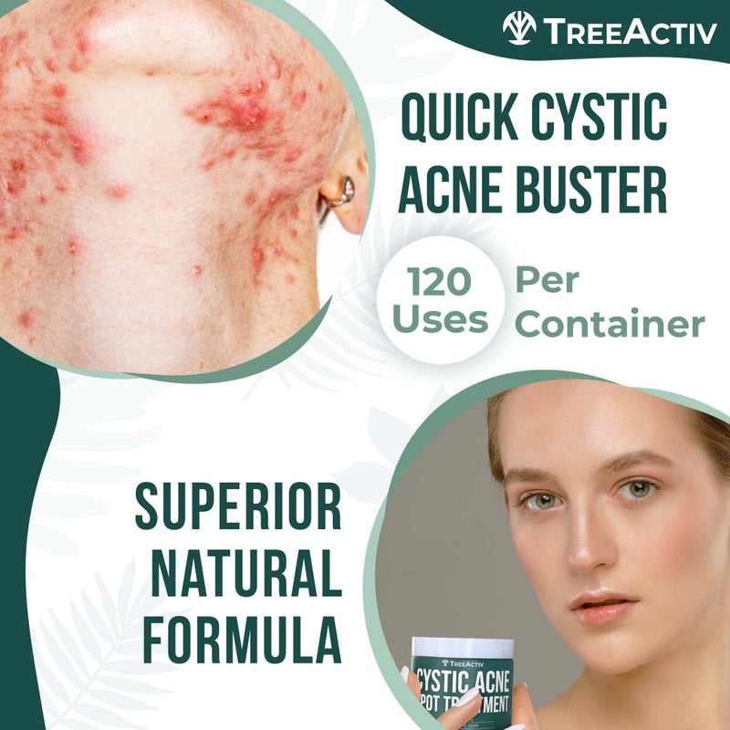 TreeActiv Cystic Acne Spot Treatment Paste with Sulfur, Bentonite Clay, and Tea Tree Oil, Deep Breakouts, 20-Minute or Overnight Application, Suitable for Face and Body, 0.5 oz (120+ Uses) - Image 4