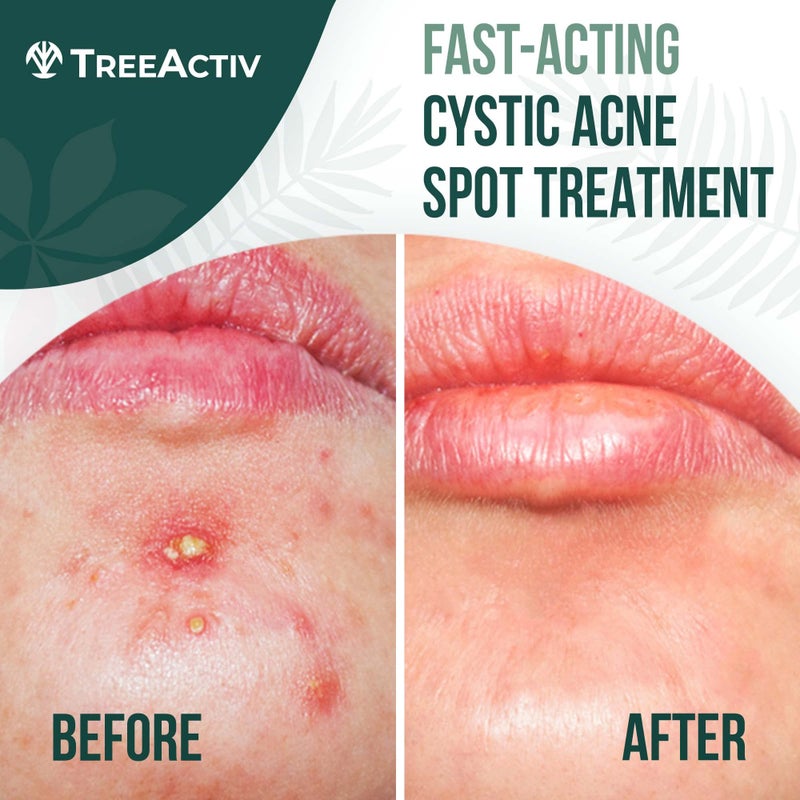 TreeActiv Cystic Acne Spot Treatment Paste with Sulfur, Bentonite Clay, and Tea Tree Oil, Deep Breakouts, 20-Minute or Overnight Application, Suitable for Face and Body, 0.5 oz (120+ Uses) - Image 2