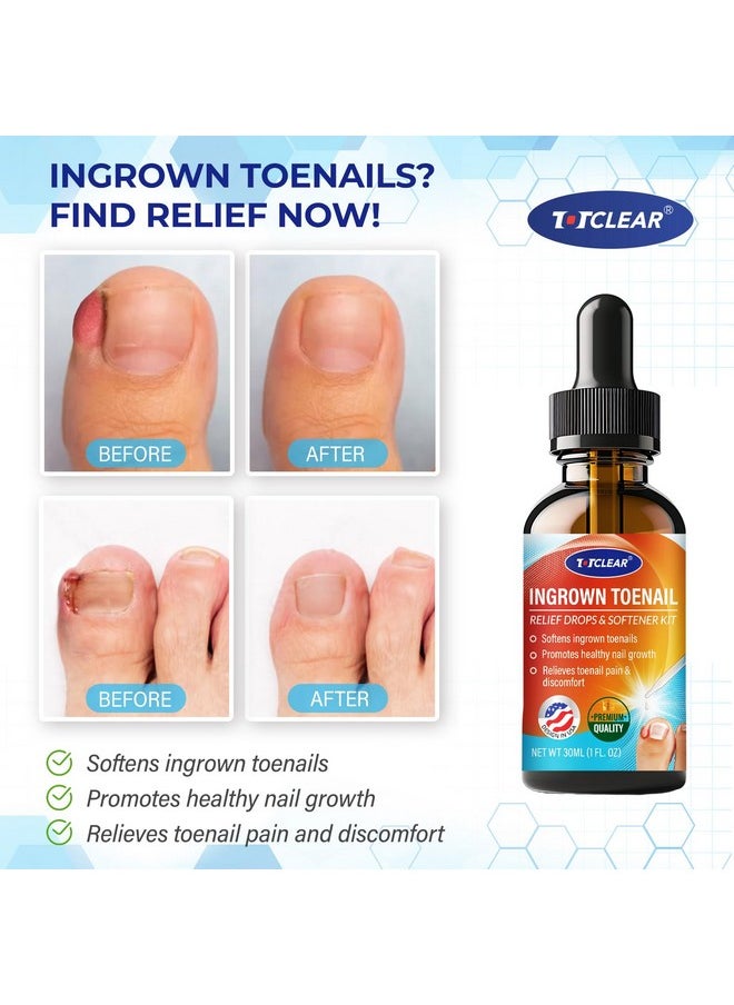 TOTCLEAR Ingrown Toenail Relief: Ingrown Toenail Tool for Men Women - Ingrown Toenail Removal Kit - Ingrown Toenail Corrector Drops - Ingrown Toenail Remover - Effective Solution for Ingrown Toenails - 30ml  - Image 2