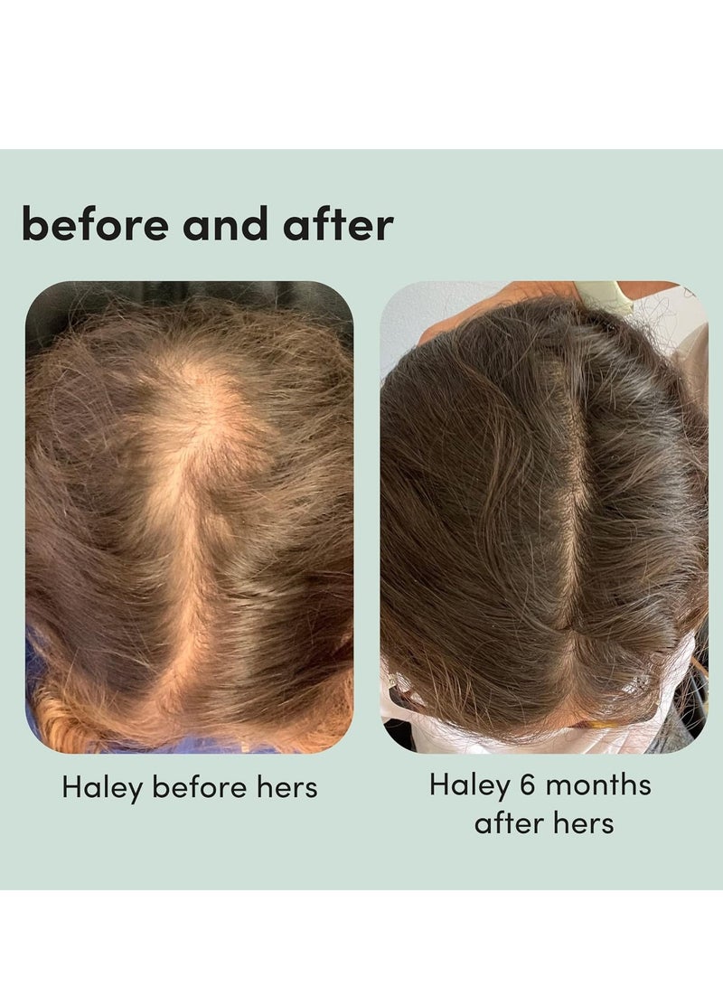 Hers Hers Triple Threat Shampoo, Conditioner and Minoxidil Set - Hair Loss Treatment For Women - Includes Foam 5% Minoxidil Treatment, Color Safe Hair Thickening Shampoo and Conditioner - 3 Count - Image 4