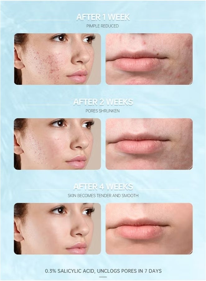 AuQuest Salicylic Acid Acne Face Cream Whitening Facial Treatment Hyaluronic Acid Black Dots Remove Skin Care Beauty Health Repairing Skin Base Essence 15ml - Image 2