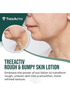 TreeActiv Rough And Bumpy Skin Lotion 8 Fl Oz With Hyaluronic Acid Shea Butter And Vitamin E Nourishing Lotion For Rough And Bumpy Skin Moisturizing Strawberry Legs Treatment For All Skin Types  - Image 2