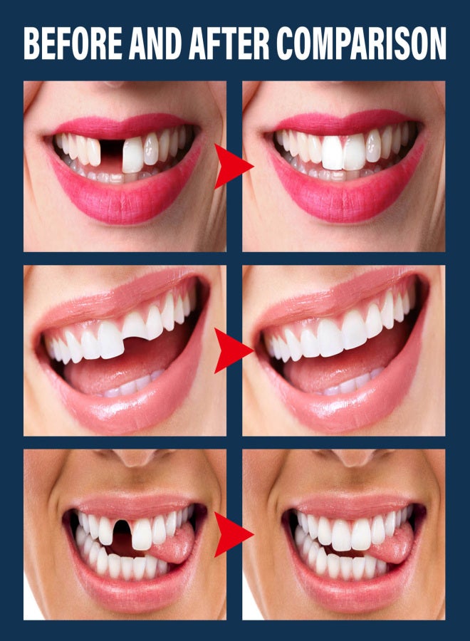 EELHOE 30ml Moldable Teeth Glue 4 Dental Tools Temporary Tooth Filling Set Difficult to Deform Smile Confidently - Image 2