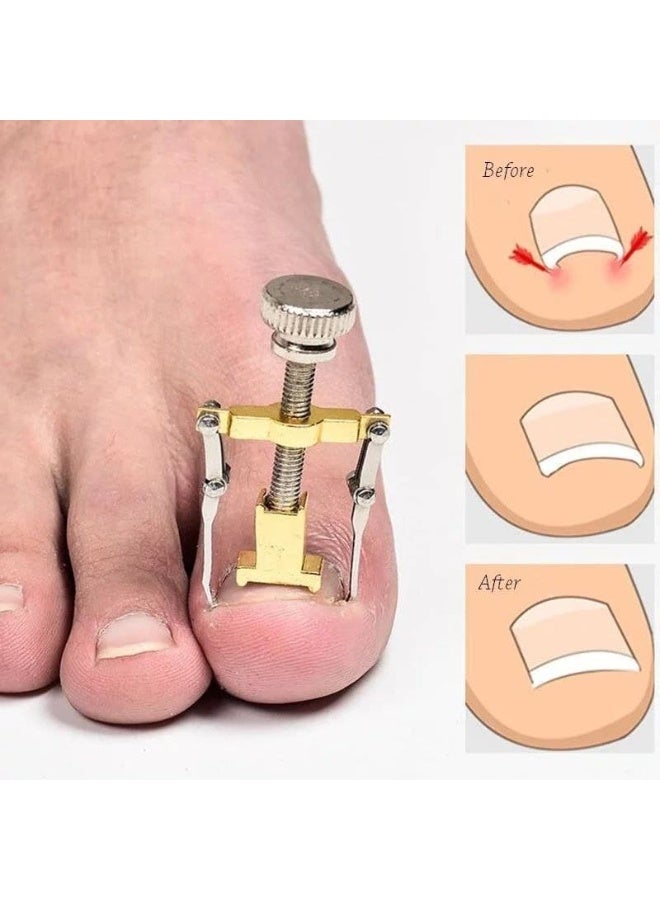 جهاز تصحيح الأظافر الغارزة - أداة علاجية احترافية للتخلص من آلام الأظافر الملتهبة - من الفولاذ المقاوم للصدأ - قابل لإعادة الاستخدام. - Image 5