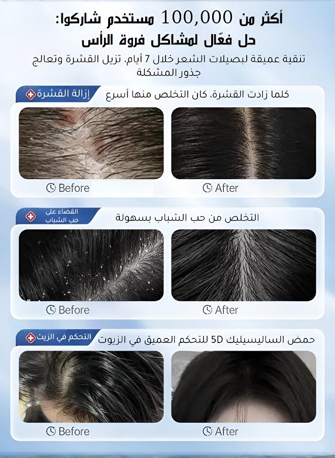 علاج فعال لفروة الرأس: شامبو مضاد للبكتيريا والعث لسعفة فروة الرأس العنيدة - شاهد النتائج في 3 أسابيع - Image 3