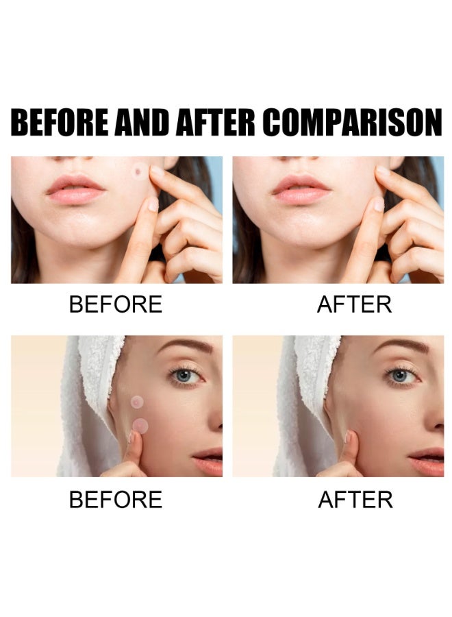 West&Month لصقات حب الشباب، 72 لصقة هيدروكولود حب الشباب، لصقات شفاء حب الشباب، غطاء غير مرئي للبقع للوجه، توفر شفاء مثالي للبشرة - Image 4