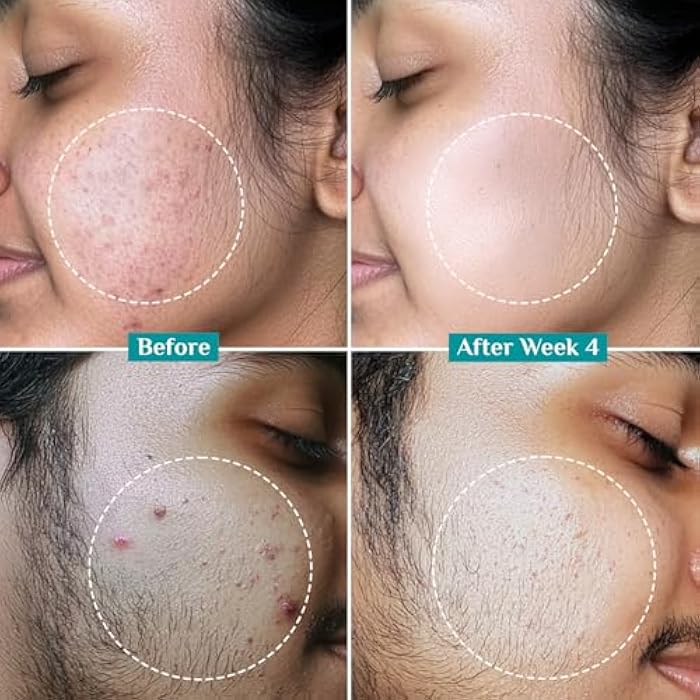 Pilgrim 2% Salicylic Acid Face Serum for Acne-Prone Skin | with Korean White Lotus | Clears Pores, Controls Oil & Fights Acne | Gentle Daily Serum | 1.01 Fl Oz (30ml) - Image 5