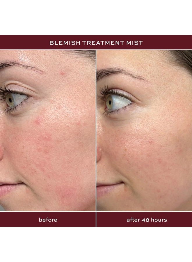 ITK Skincare 2% Salicylic Acid Spray for Face & Body Acne - Blemish-Fighting Treatment for Body Acne, Bacne, Blackheads, Pimples & Blemishes - BHA Blemish Facial Mist Post Workout - 3.3oz Spray Bottle - Image 2