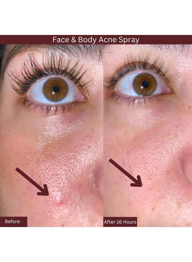 ITK Skincare 2% Salicylic Acid Spray for Face & Body Acne - Blemish-Fighting Treatment for Body Acne, Bacne, Blackheads, Pimples & Blemishes - BHA Blemish Facial Mist Post Workout - 3.3oz Spray Bottle - Image 4