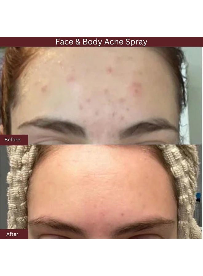 ITK Skincare 2% Salicylic Acid Spray for Face & Body Acne - Blemish-Fighting Treatment for Body Acne, Bacne, Blackheads, Pimples & Blemishes - BHA Blemish Facial Mist Post Workout - 3.3oz Spray Bottle - Image 3