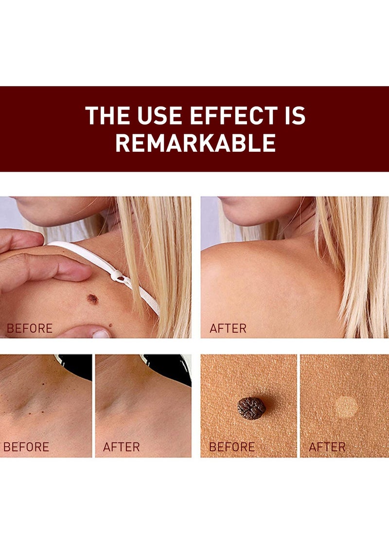 Jaysuing Supwell Wart Removing Pen, Common Mole Skin Tag Remover, Fast Effective Painless Blemish Removal Wart Remover Liquid Pen Gel for Skin Warts Tag Mole (3ml)  - Image 3