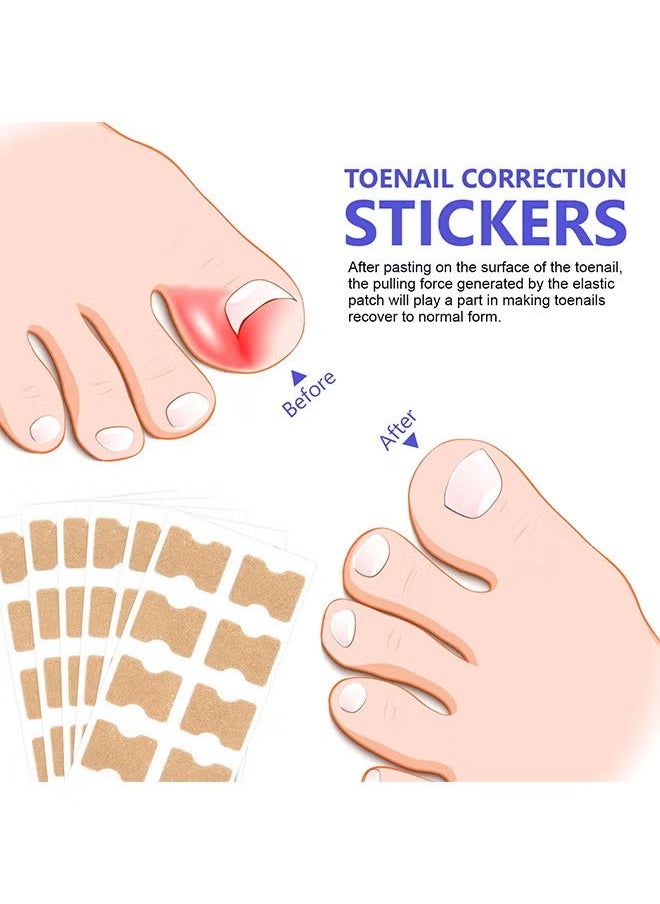 Sefudun - Ingrown Toenail Corrector Patch, 100PCS Ingrown Toenail Corrector Strips, Toenail Correction Patches, Ingrown Toenail Treatment Tool Foot Care, No-Glue Toenail Correction Stickers - Image 1