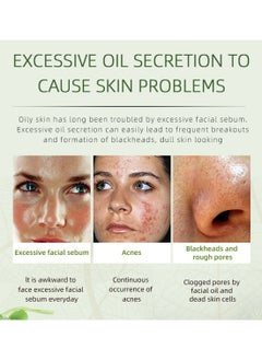 JoyPretty Herbal Acne Removing Cream, Anti-Inflammation Acne Treatment Face Cream with Tea Tree Oil, Acne Spot Treatment for Face and Acne Dots, Inflammation Relief 50g  - Image 4