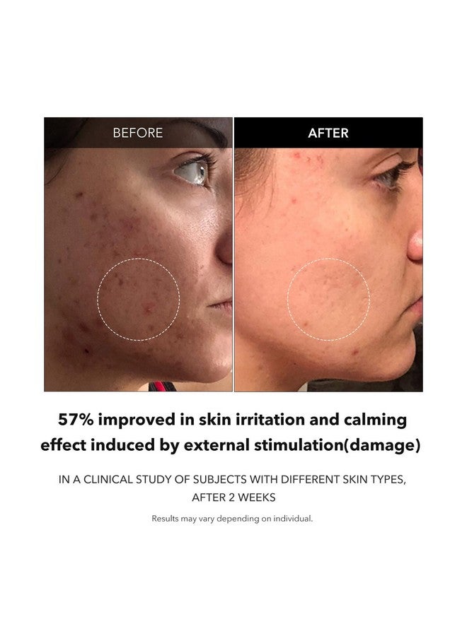 APRILSKIN Carrotene Clarifying Facial Serum | Vegan Noncomedogenic | Blemish Clear Dark Spot Corrector Poretightening | Korea Skin Care | Acneprone Skin Oily Irritated Uneven | 1.25 Fl.Oz - Image 4