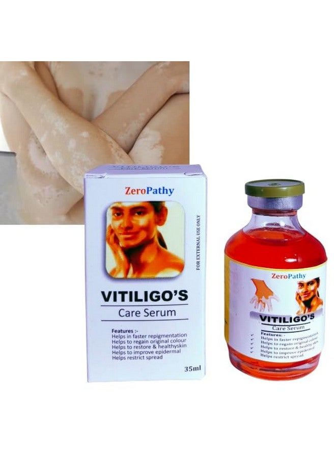 Zero Pathy مرهم البقع البيضاء، لعلامات البياض، فيتيليغو طبيعي مع الكركم، الألوة فيرا والجينسنغ، مصمم لاستعادة تصبغ الجلد، سيروم إزالة علامات الترطيب لعلاج الأمراض - Image 1