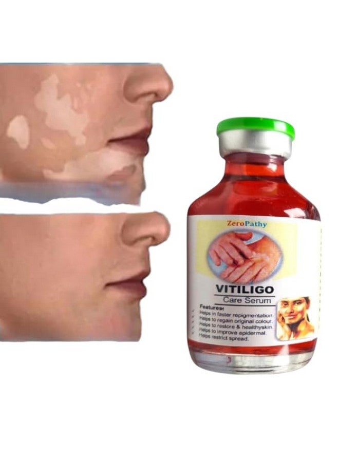 Zero Pathy مرهم البقع البيضاء، لعلامات البياض، فيتيليغو طبيعي مع الكركم، الألوة فيرا والجينسنغ، مصمم لاستعادة تصبغ الجلد، سيروم إزالة علامات الترطيب لعلاج الأمراض - Image 3