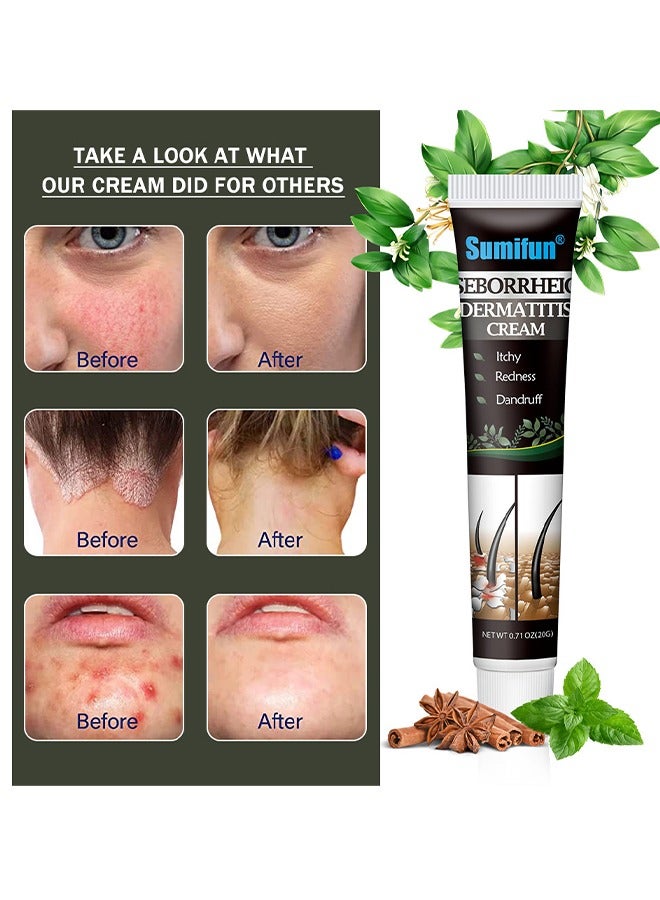 Sumifun Seborrheio Dermatitis Cream - Scalp care cream,cream For Scalp Prone To Folliculitis, Dermatitis, Dandruff, Mites, Itchy And Flaky Scalp, Treats Dandruff And Seborrheic Dermatitis - Image 5