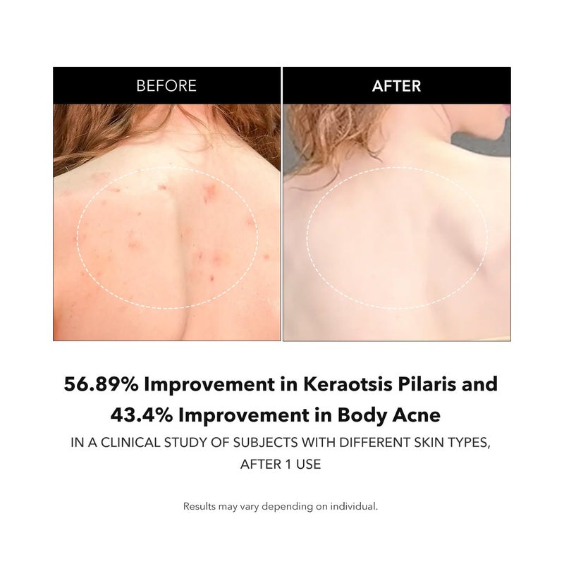 APRILSKIN Carrotene IPMPâ„¢ Exfoliating Body Wash | Salicylic Acid Body Wash Improve Rough & Bumpy Skin, Body Acne, Keratosis Pilaris with Niacinamide & Ceramides | Vegan & Cruelty-free | 10.14 fl.oz - Image 4