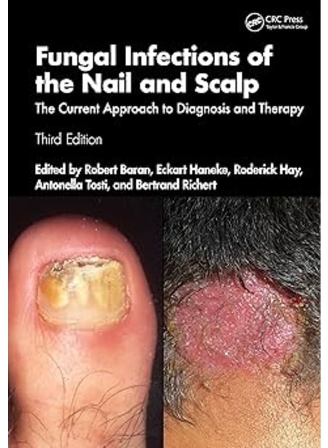 Fungal Infections of the Nail and Scalp: The Current Approach to Diagnosis and Therapy