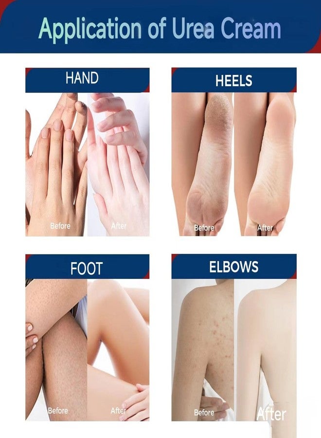 OUKEYA Urea Cream 42 Percent with 2% Salicylic Acid Tube 3 Oz, Foot & Hand Cream for Dry Cracked, 3 Pack - Image 5
