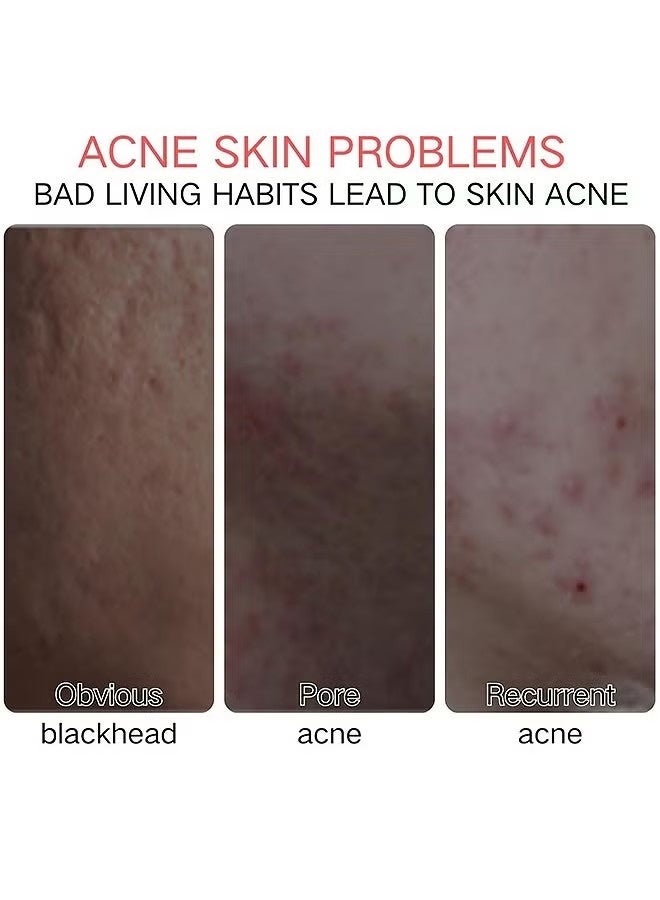 FUSHITING Azelaic Acid 15% Acne Tratment Cream, Acne Cream for Face, Spot Treatment, Anti Acne Gel For Spot Prone Skin, Rosacea Reducing Relief Pimple Breakouts Blackhead Pigmentation and Redness,Hydrate 15g - Image 4