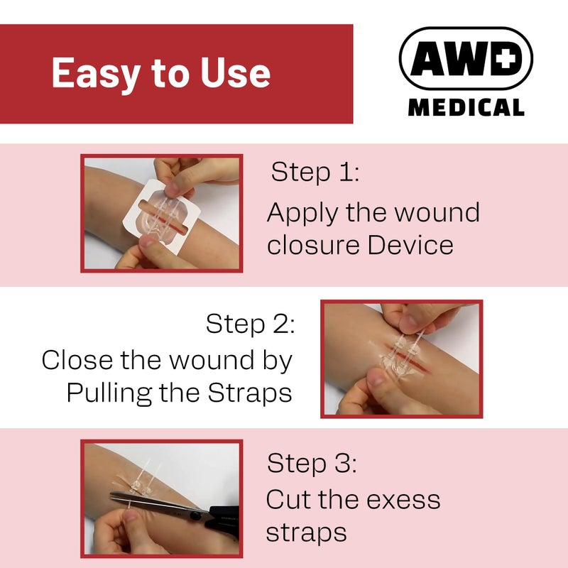 AWD Medical AWD Zip Stitch Wound Closure Strips - 2 Zipstitch Devices, 2 Sterile Gauzes, 2 Alcohol Wipes - Emergency Laceration Device for Cuts Without Stitches - Steri Strips First Aid & Survival - Image 5