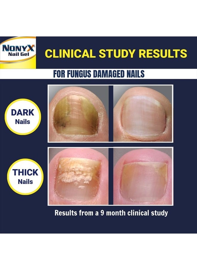 Fungal Nail Clarifying Gel | Rids Nails of Fungus by Removing Keratin Debris Where Nail Fungus Grows | 90% of Toenails Improved Using this Toenail Fungus Treatment | 4 oz