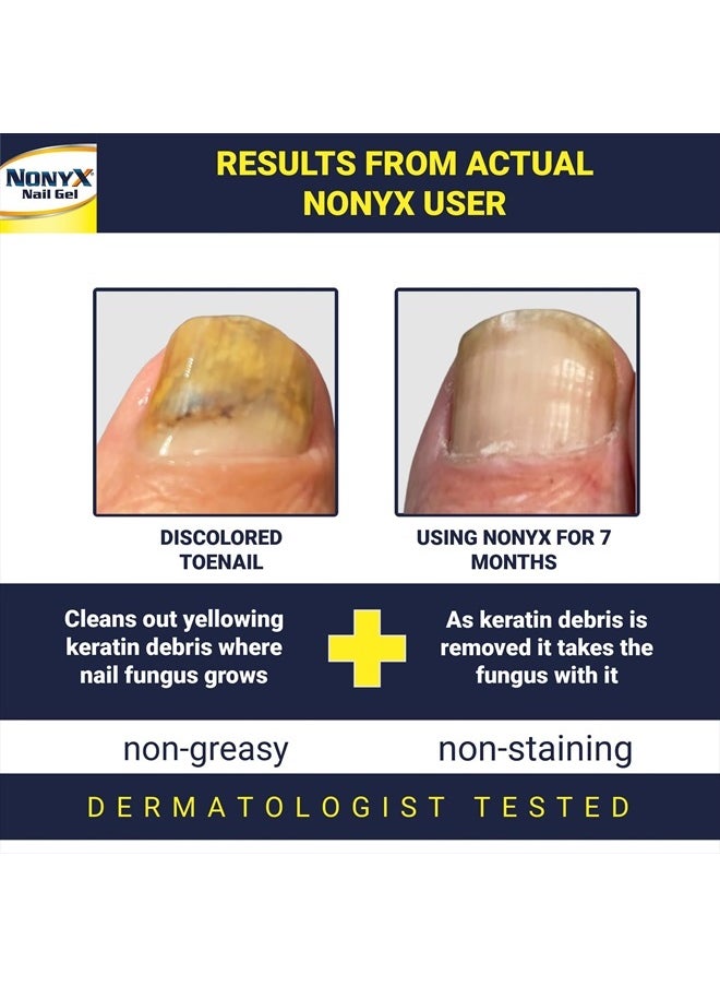 Fungal Nail Clarifying Gel | Rids Nails of Fungus by Removing Keratin Debris Where Nail Fungus Grows | 90% of Toenails Improved Using this Toenail Fungus Treatment | 4 oz