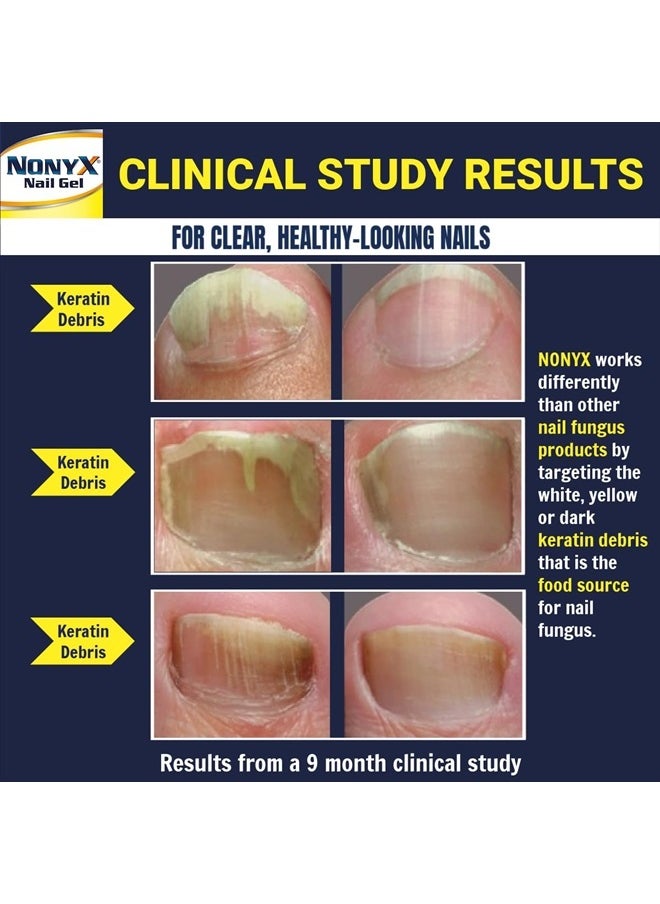 Fungal Nail Clarifying Gel | Rids Nails of Fungus by Removing Keratin Debris Where Nail Fungus Grows | 90% of Toenails Improved Using this Toenail Fungus Treatment | 4 oz