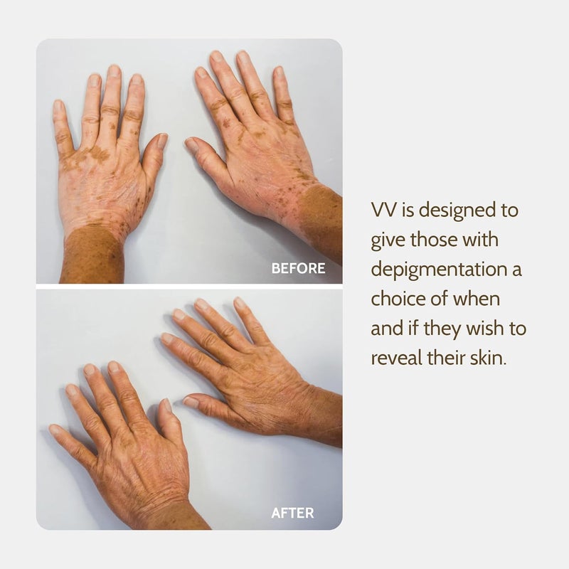 Fake Bake Vitiligo Vanquish Cosmetic Camouflage Kit - Liquid Concealer for Skin Depigmentation - Image 3